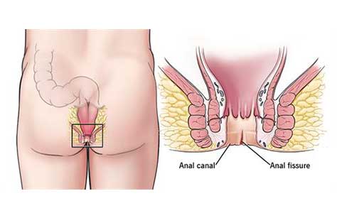 Anal Fissure